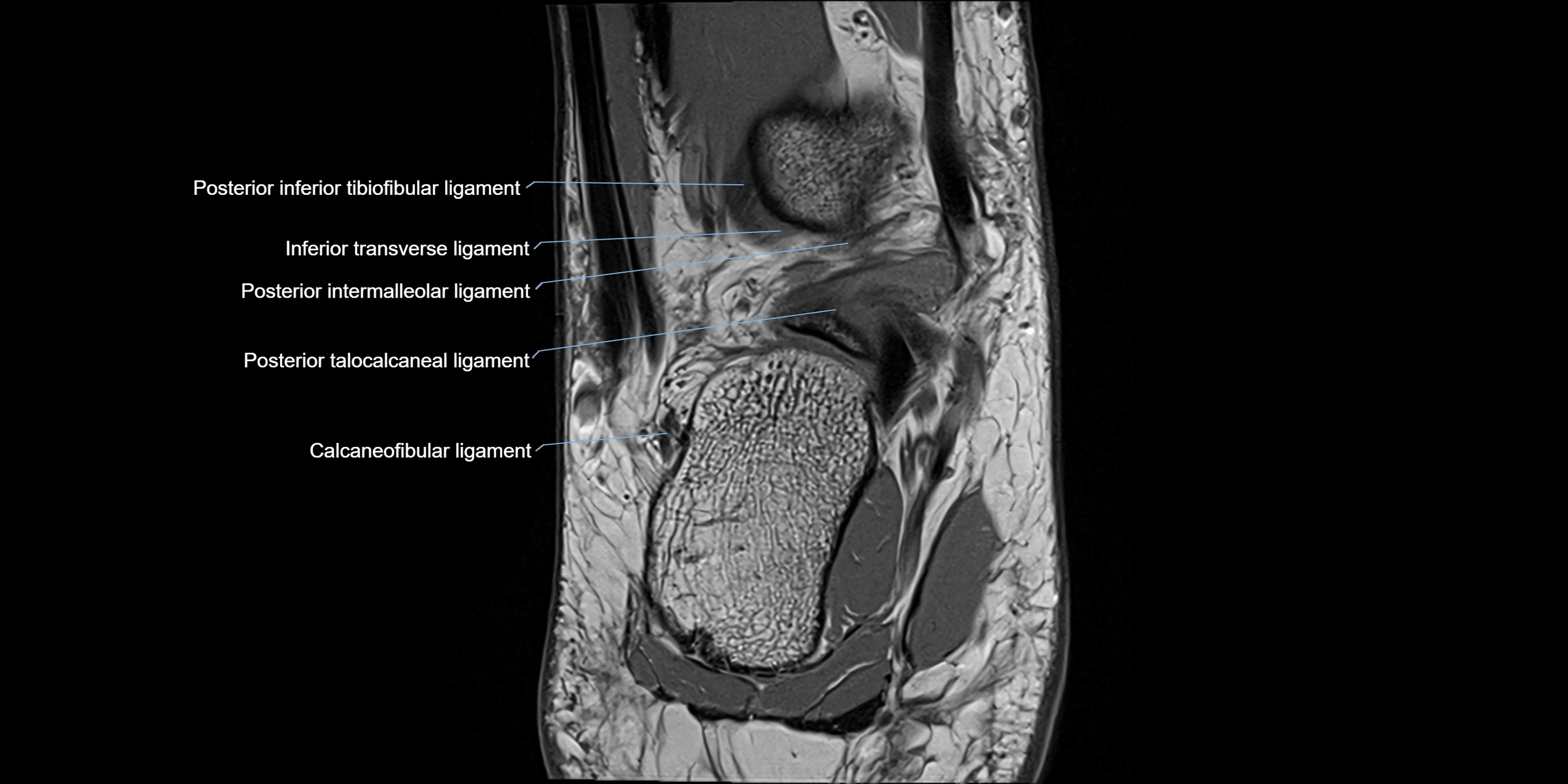 MRI Ankle coronal ligaments cross sectional anatomy 3T  radiology  image-img-00001-00019.webp
